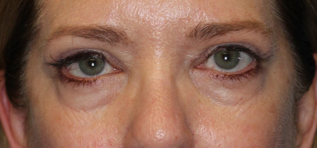 Upper Eyelid Lift After