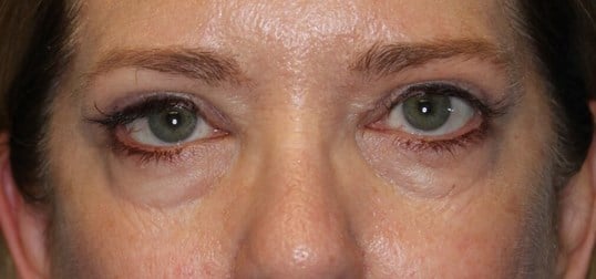 Upper Eyelid Lift After