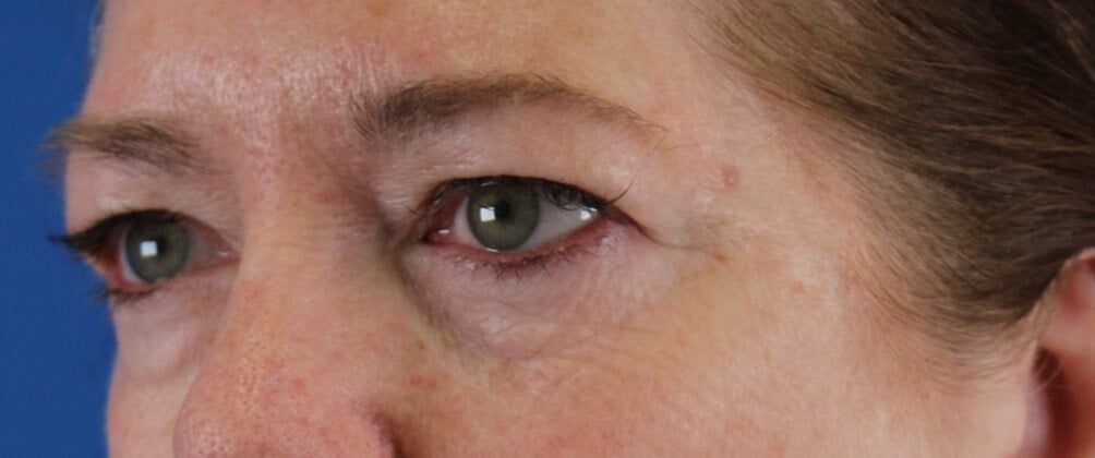 Upper Eyelid Lift Before