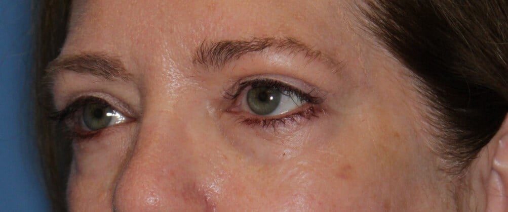 Upper Eyelid Lift After