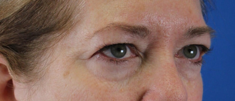Upper Eyelid Lift Before