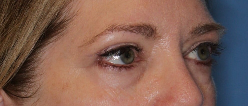 Upper Eyelid Lift After