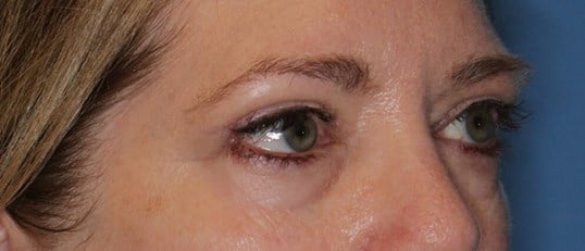 Upper Eyelid Lift After