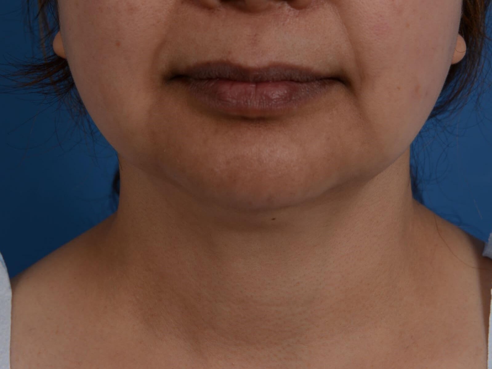Nonsurgical Jaw Contouring Before