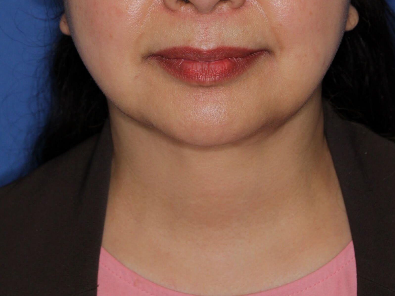 Nonsurgical Jaw Contouring After