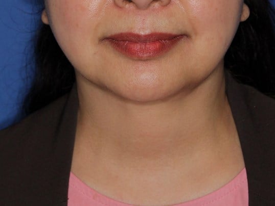 Nonsurgical Jaw Contouring After