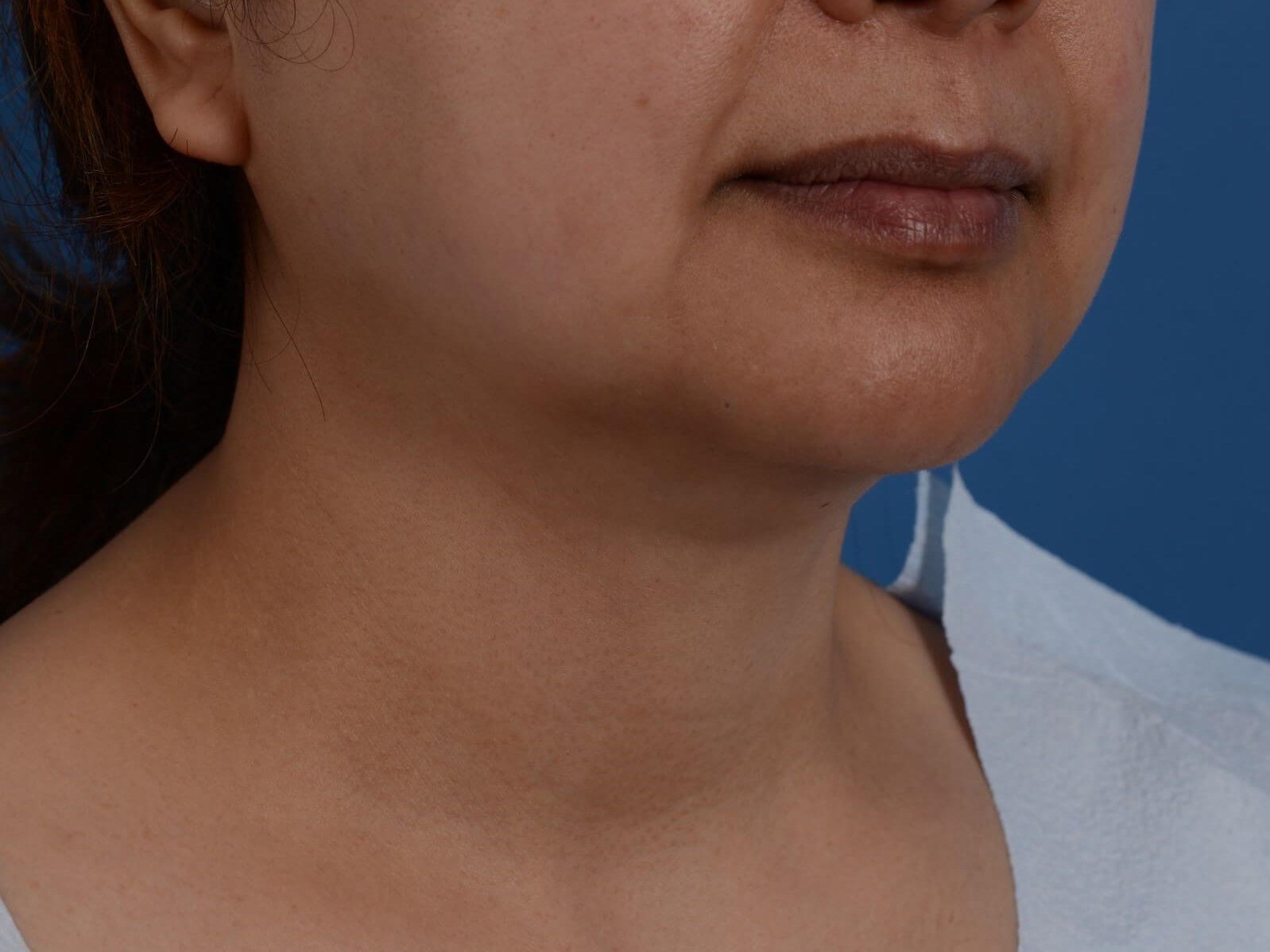 Nonsurgical Jaw Contouring Before