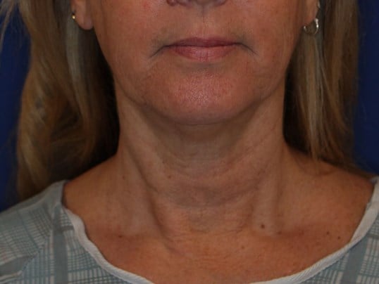 Nonsurgical Skin Tightening Before