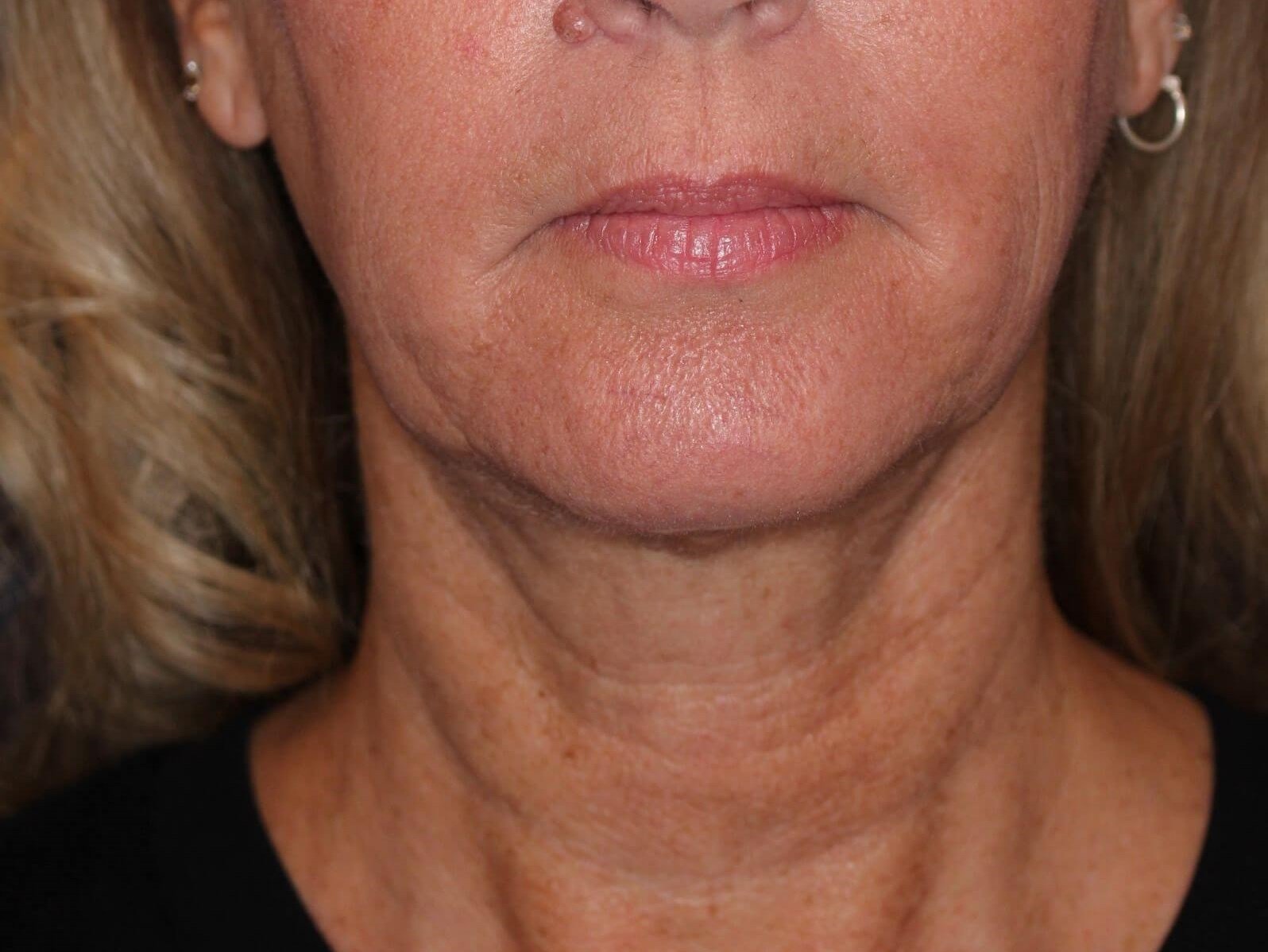 Nonsurgical Skin Tightening After