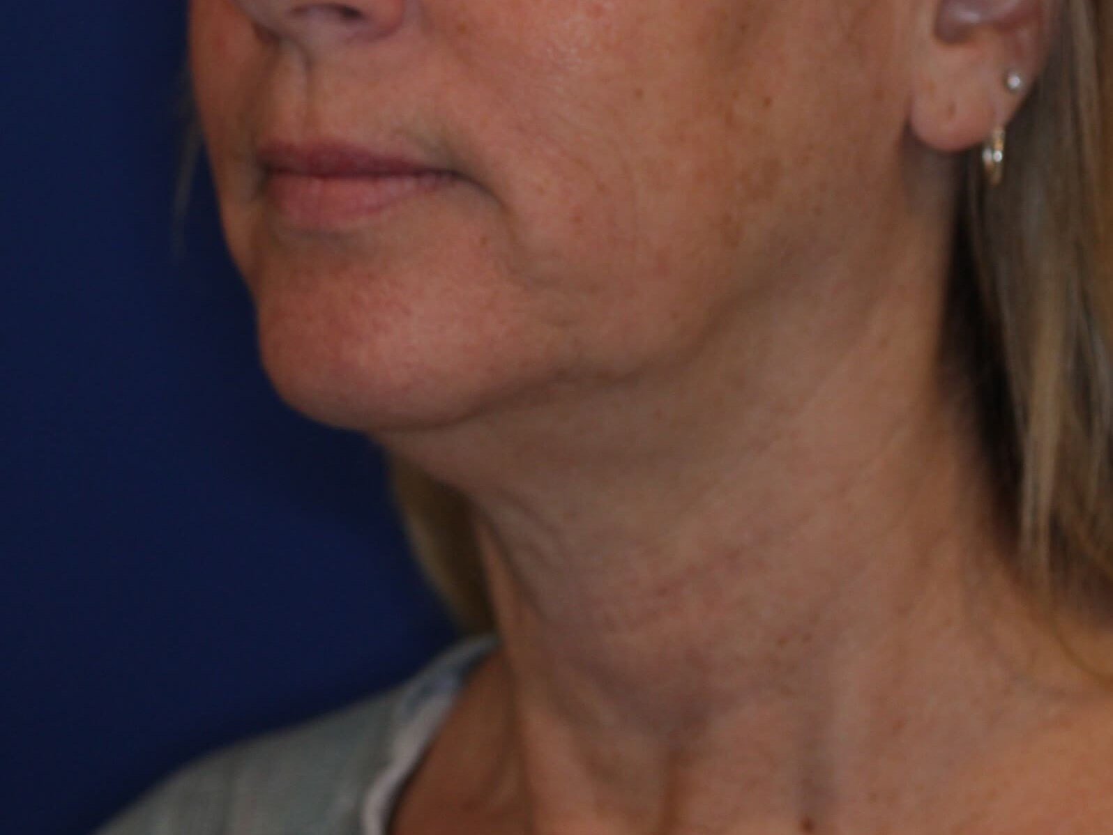 Nonsurgical Skin Tightening Before
