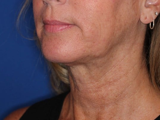 Nonsurgical Skin Tightening After
