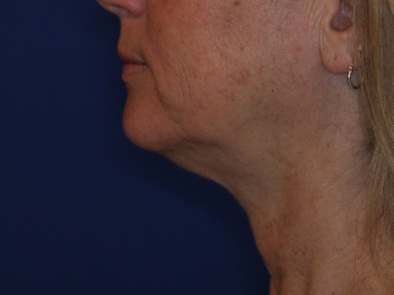 Nonsurgical Skin Tightening Before