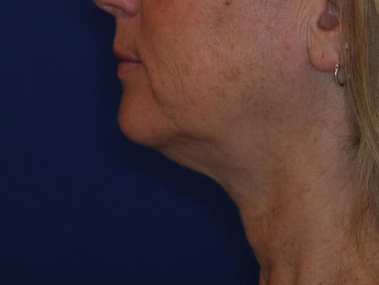 Nonsurgical Skin Tightening Before