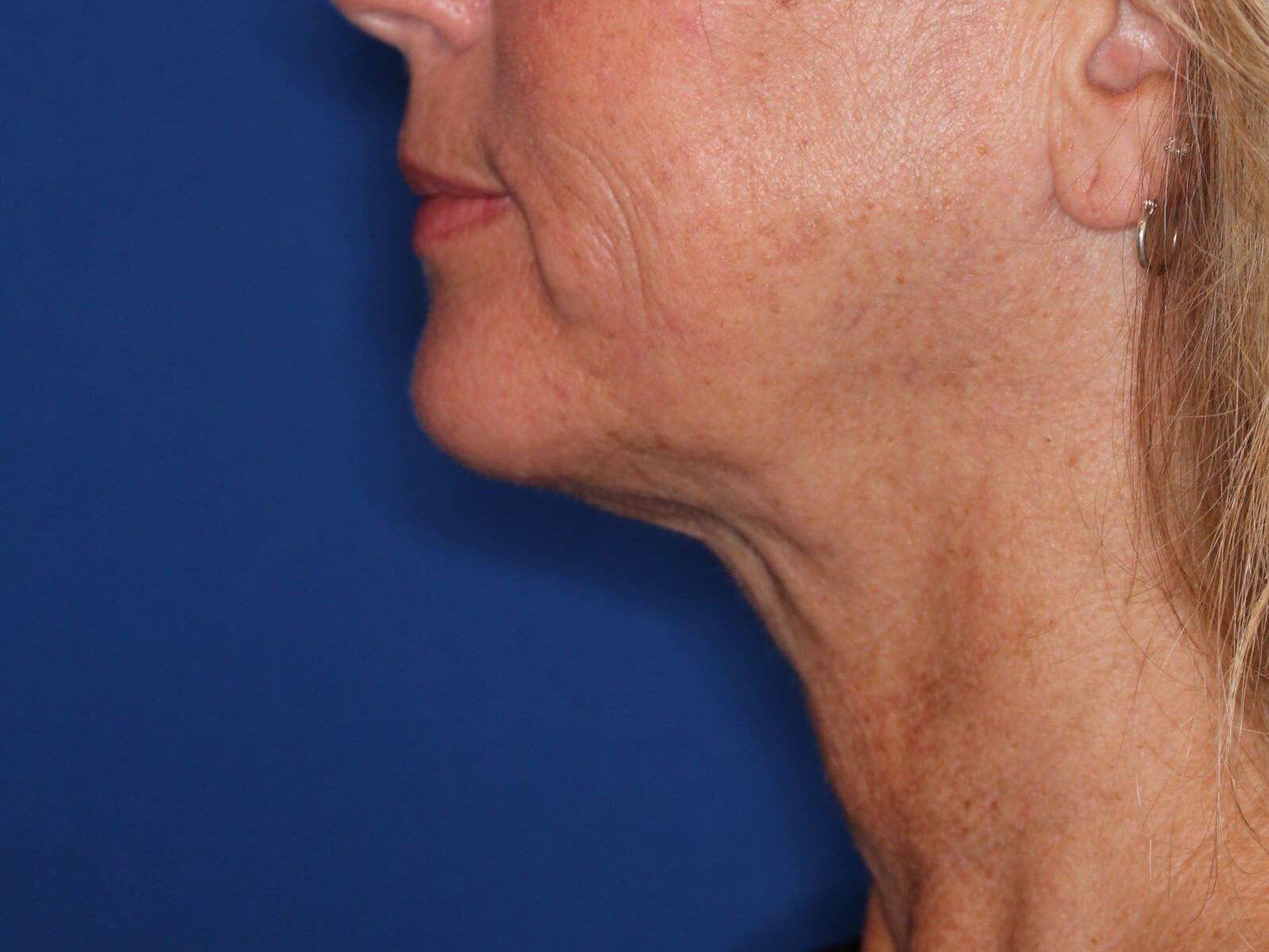 Nonsurgical Skin Tightening After