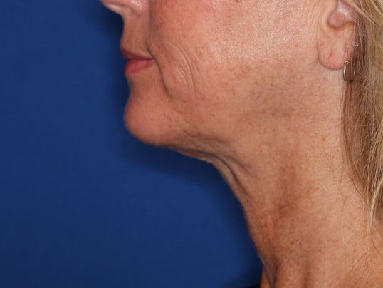 Nonsurgical Skin Tightening After
