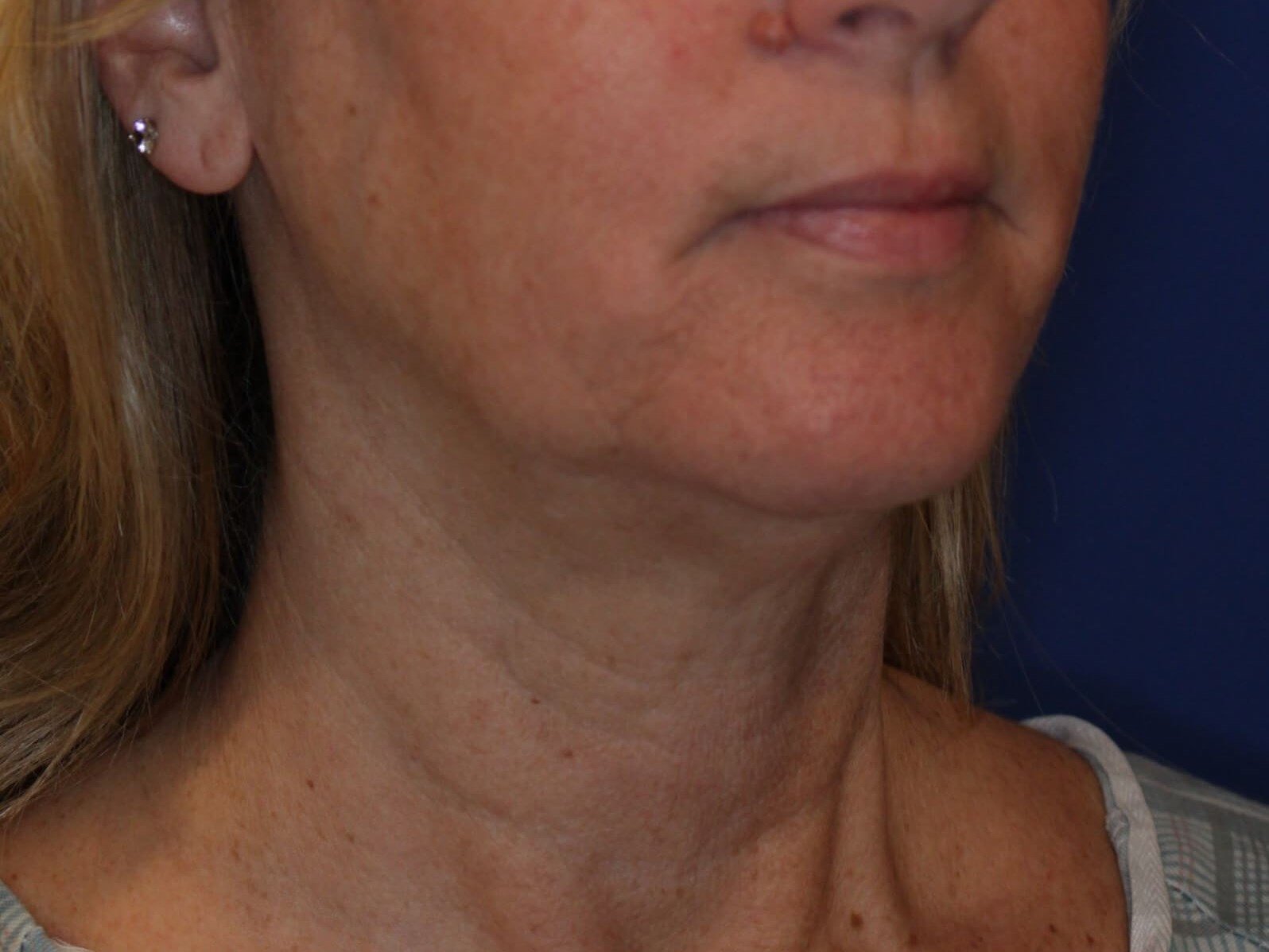 Nonsurgical Skin Tightening Before