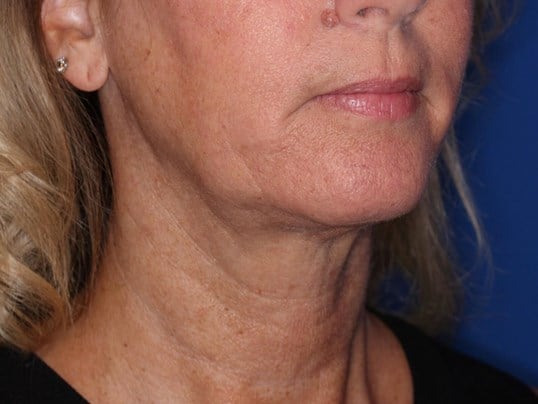 Nonsurgical Skin Tightening After
