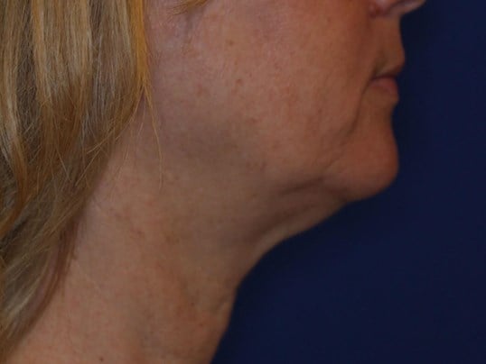 Nonsurgical Skin Tightening Before