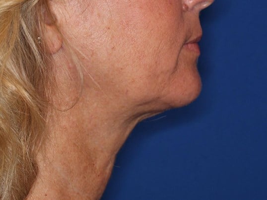 Nonsurgical Skin Tightening After