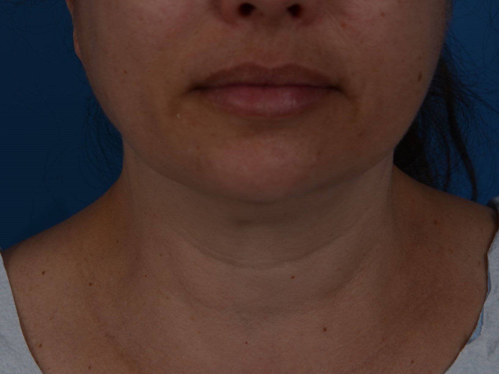 Nonsurgical Jaw Contouring Before
