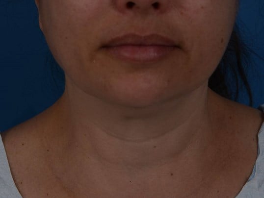 Nonsurgical Jaw Contouring Before