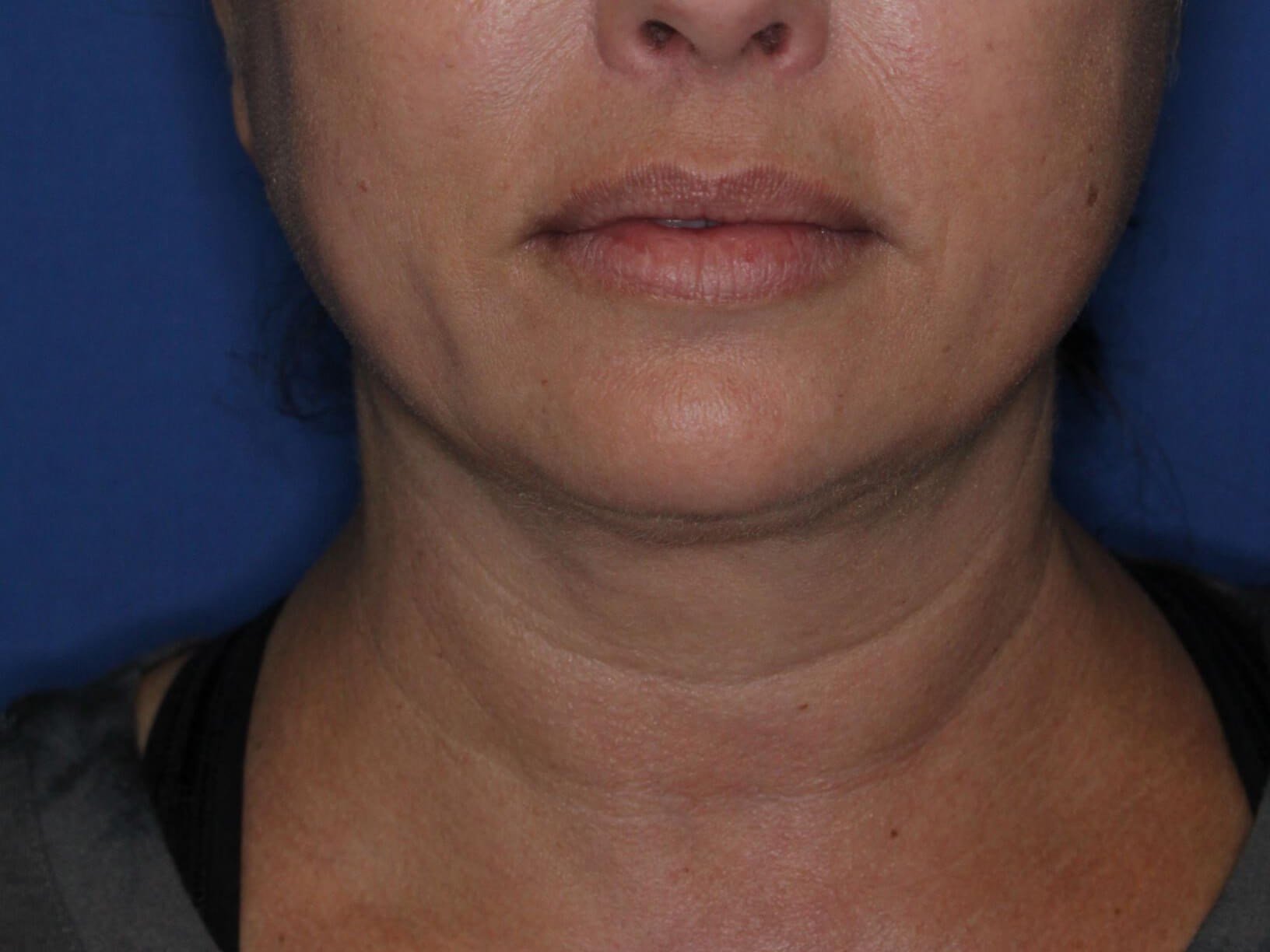 Nonsurgical Jaw Contouring After