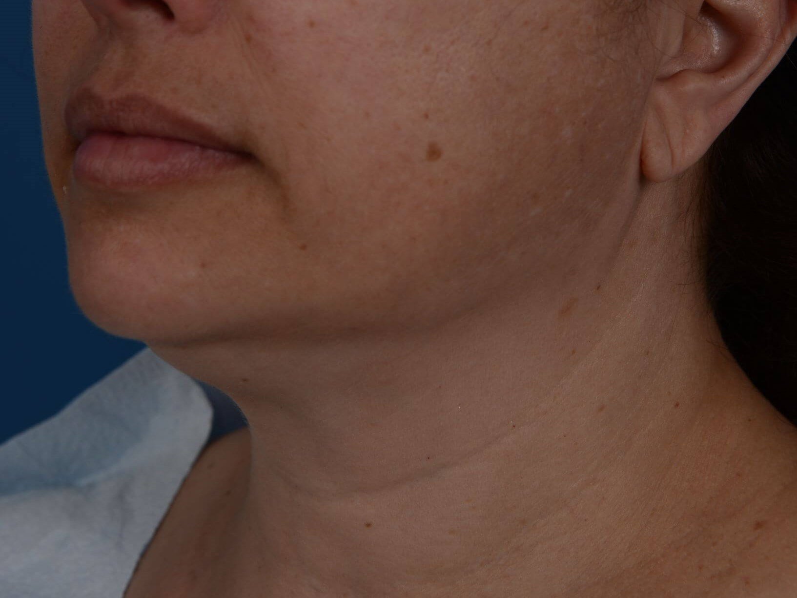 Nonsurgical Jaw Contouring Before