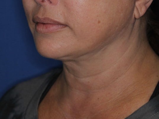 Nonsurgical Jaw Contouring After