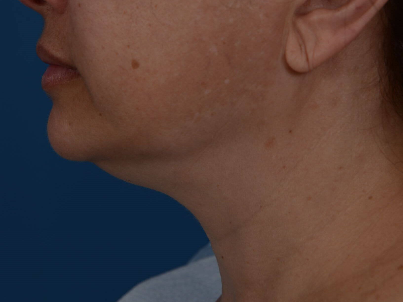 Nonsurgical Jaw Contouring Before