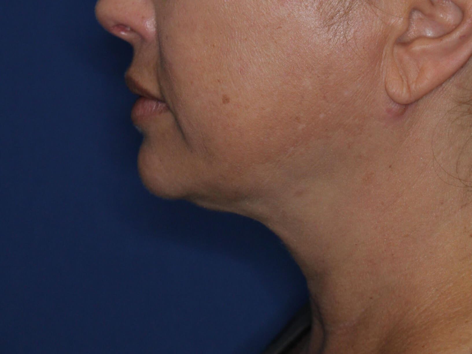 Nonsurgical Jaw Contouring After