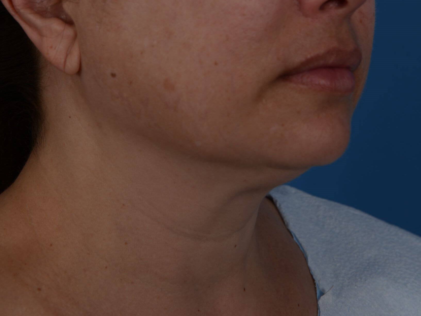 Nonsurgical Jaw Contouring Before