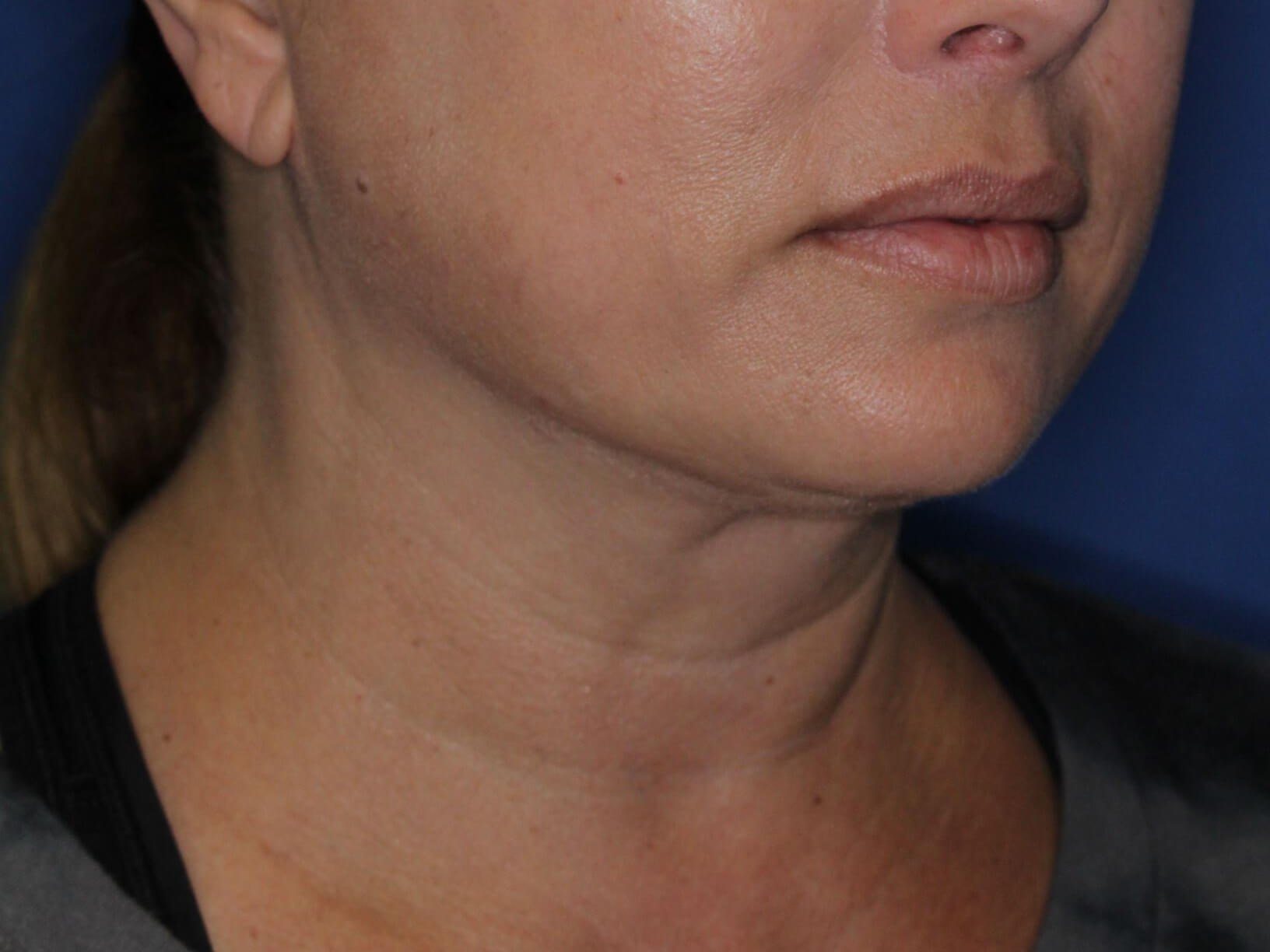 Nonsurgical Jaw Contouring After