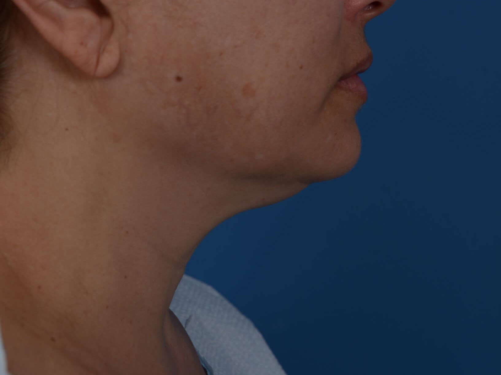 Nonsurgical Jaw Contouring Before