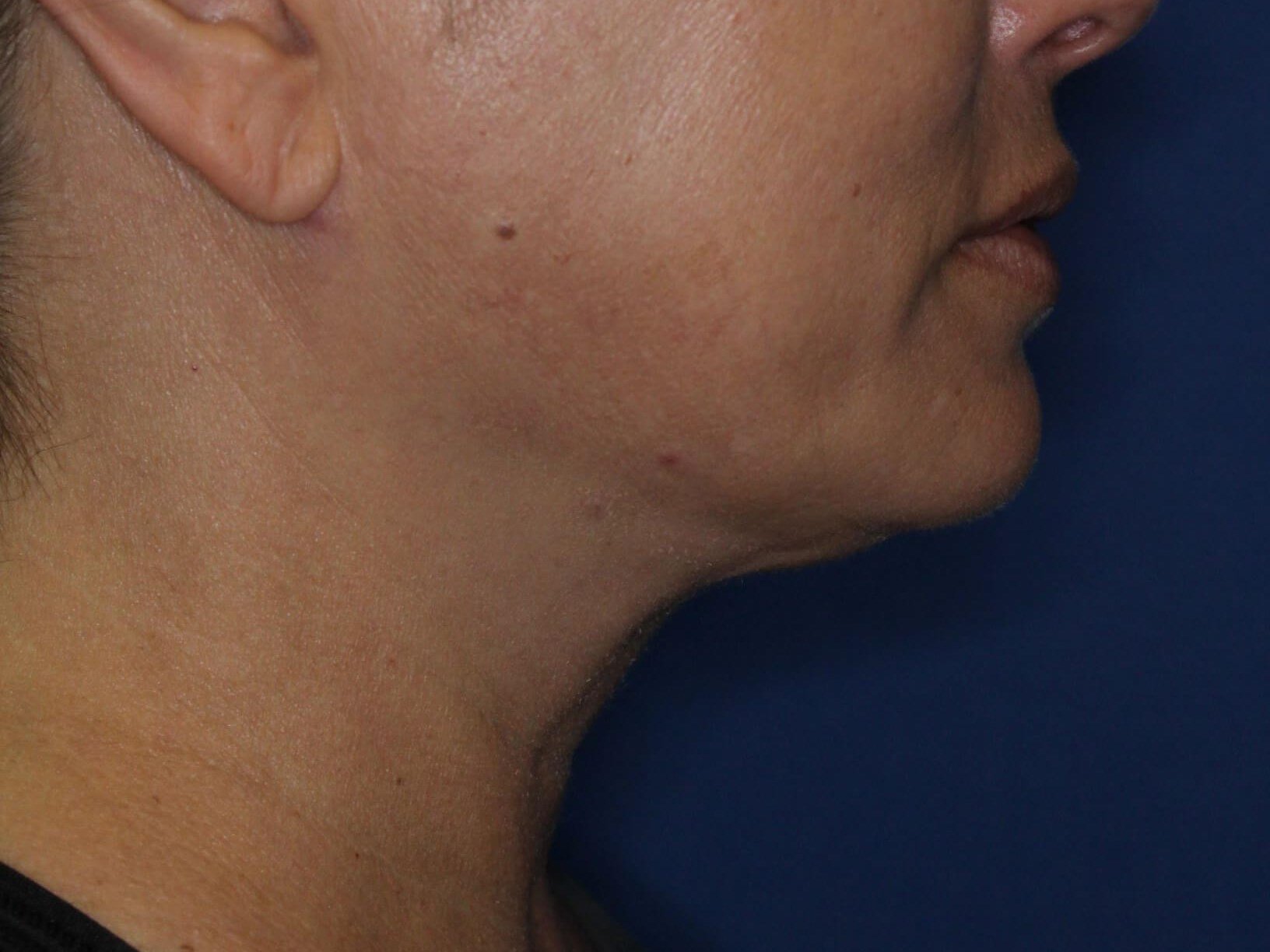 Nonsurgical Jaw Contouring After