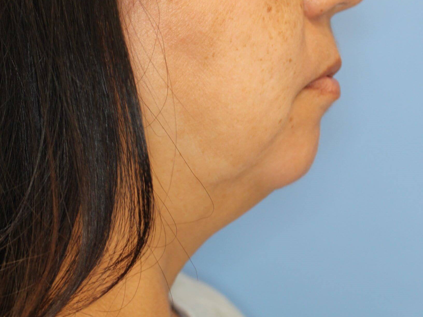 Nonsurgical Jaw Contouring Before