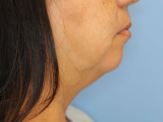 Nonsurgical Jaw Contouring Before