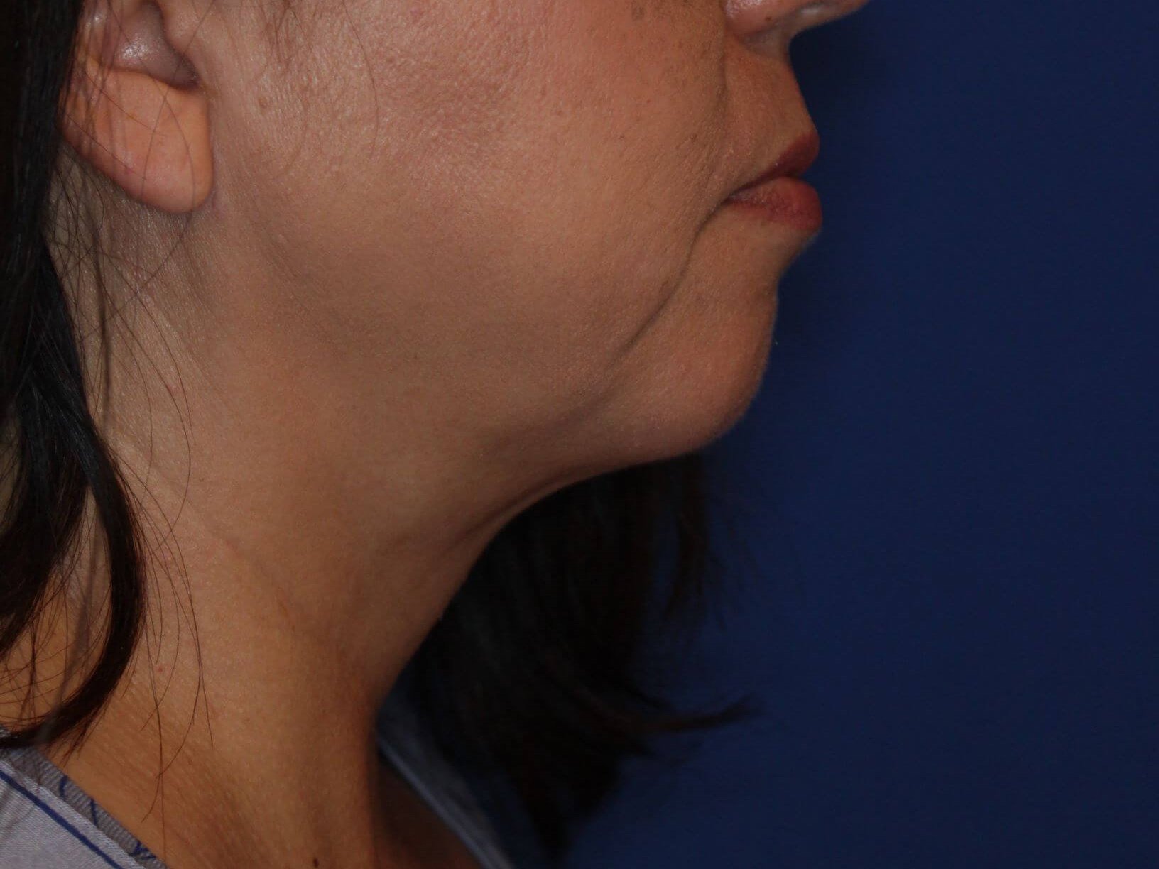 Nonsurgical Jaw Contouring After