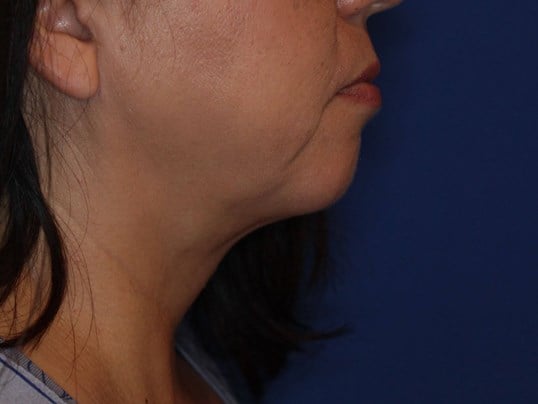 Nonsurgical Jaw Contouring After