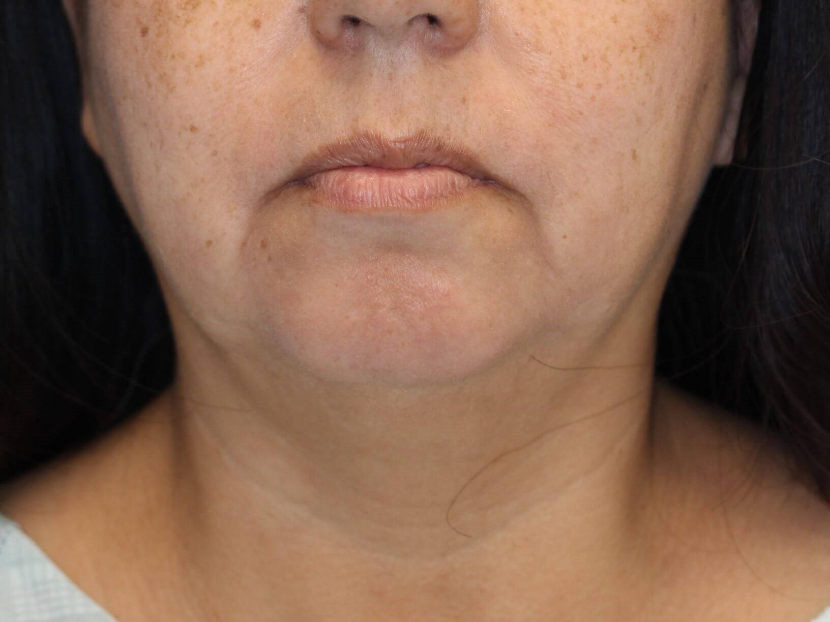 Nonsurgical Skin Tightening Before
