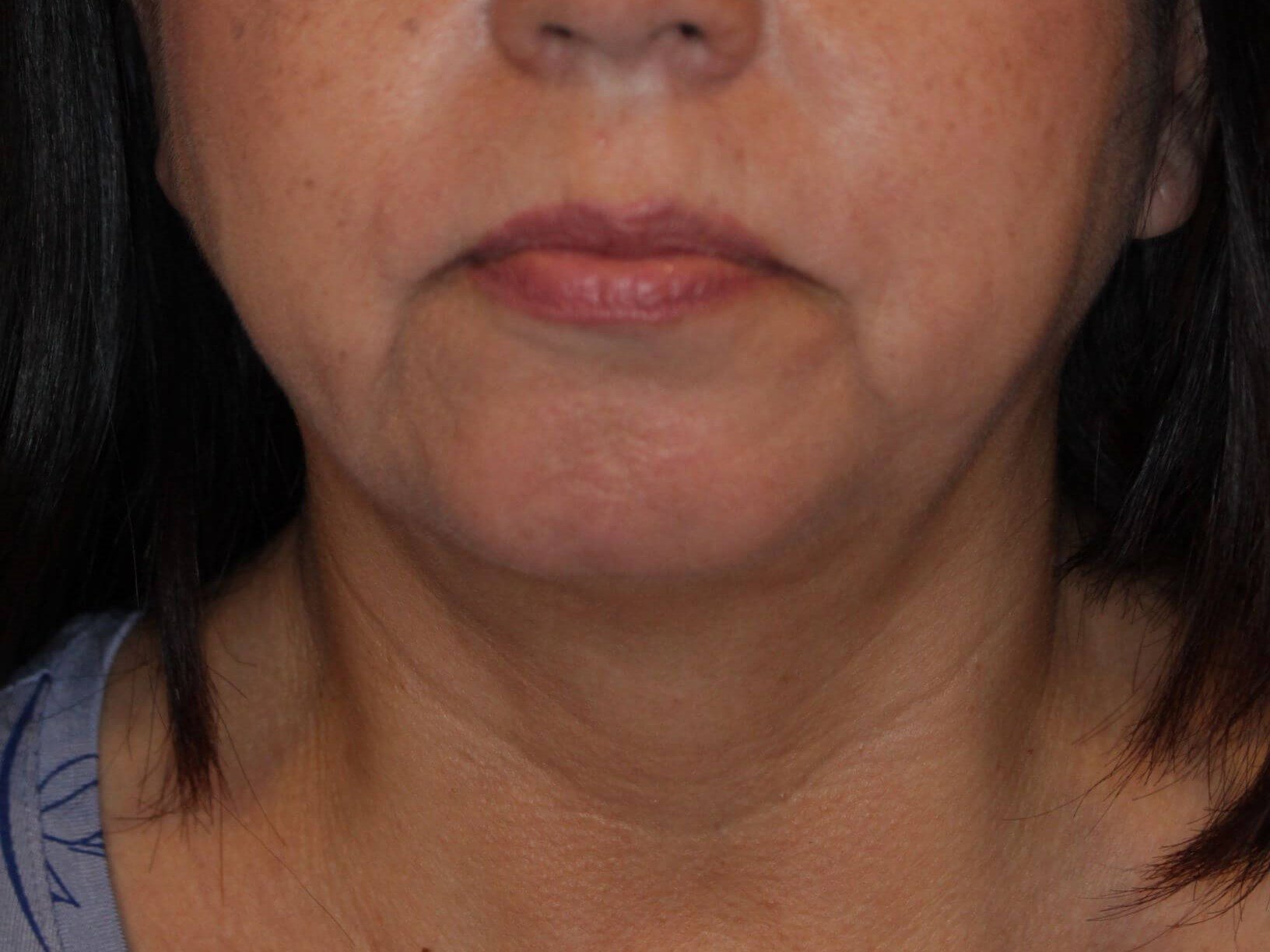 Nonsurgical Skin Tightening After