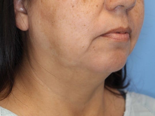 Nonsurgical Jaw Contouring Before