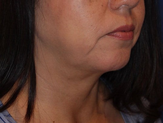 Nonsurgical Jaw Contouring After