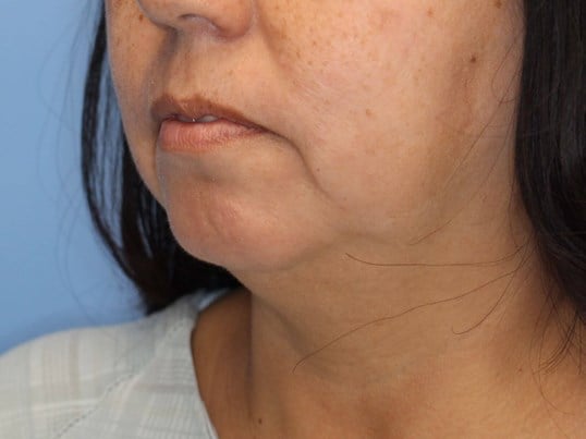 Nonsurgical Jaw Contouring Before