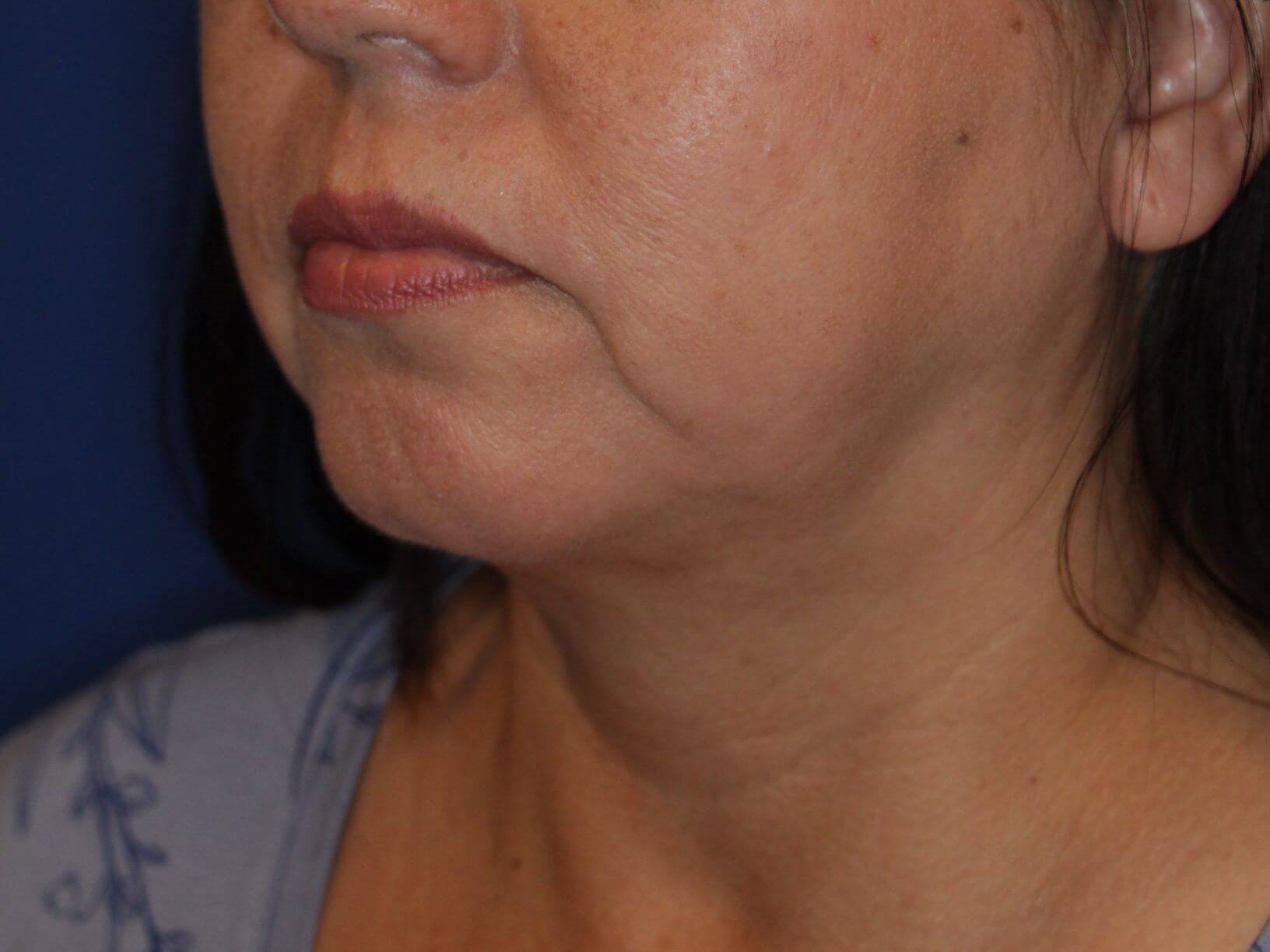 Nonsurgical Jaw Contouring After