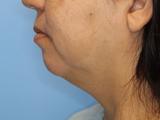 Nonsurgical Jaw Contouring Before