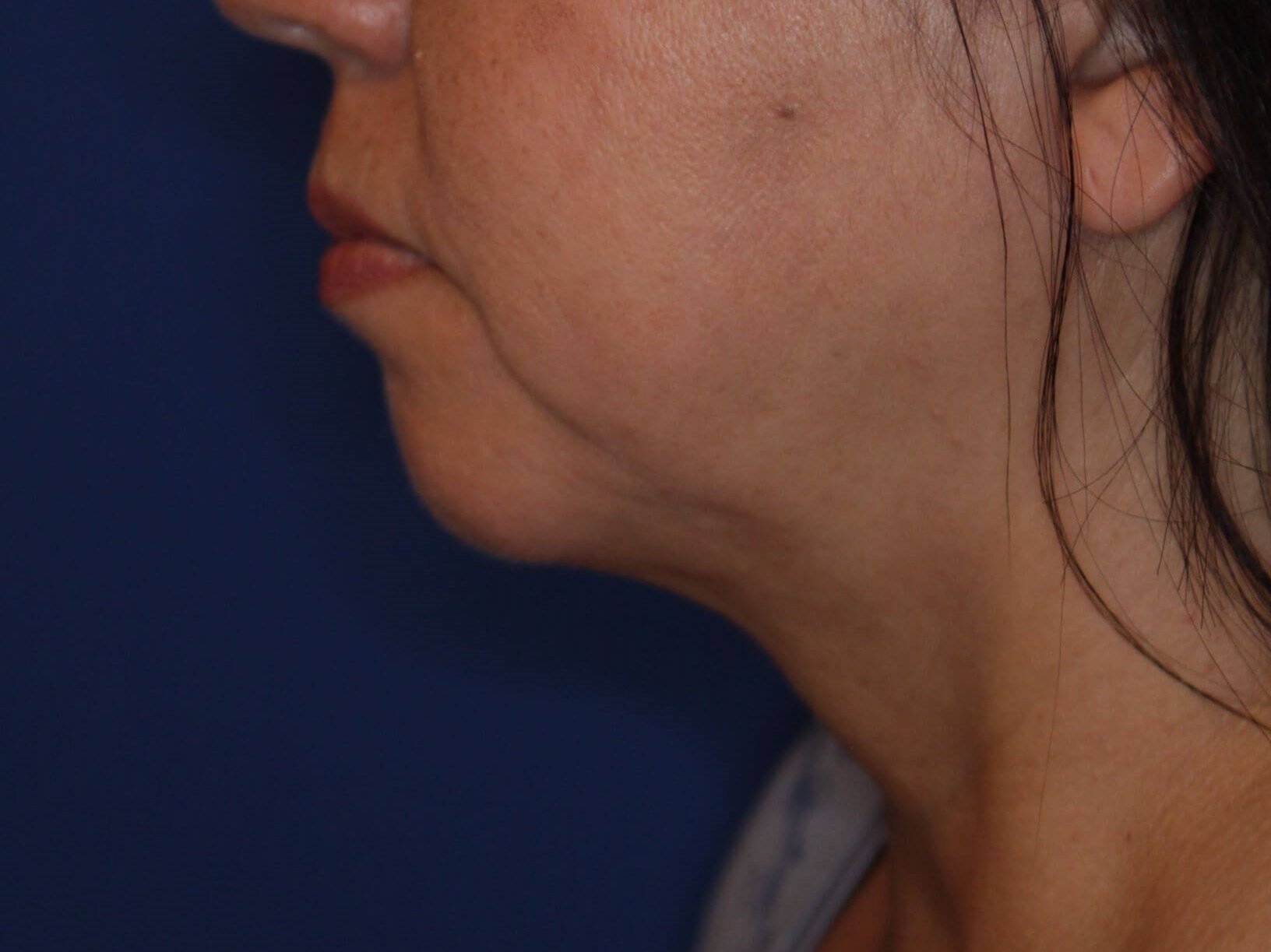 Nonsurgical Jaw Contouring After