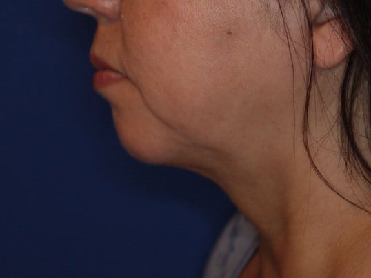 Nonsurgical Jaw Contouring After