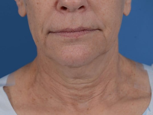 Nonsurgical Skin Tightening Before