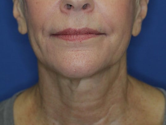 Nonsurgical Skin Tightening After