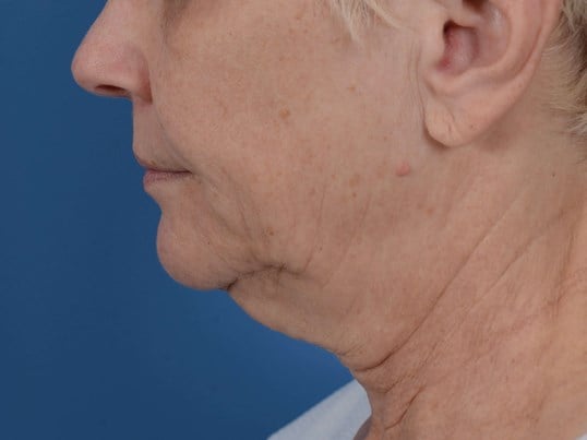 Nonsurgical Skin Tightening Before